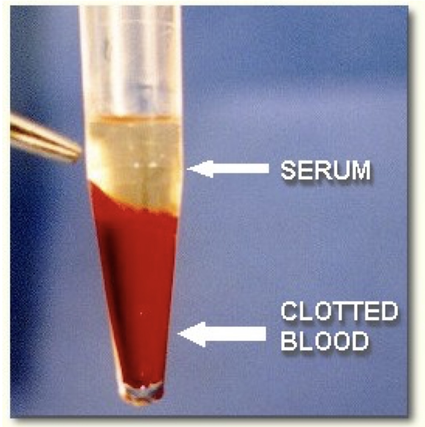 Cục máu đông tách lớp với huyết thanh