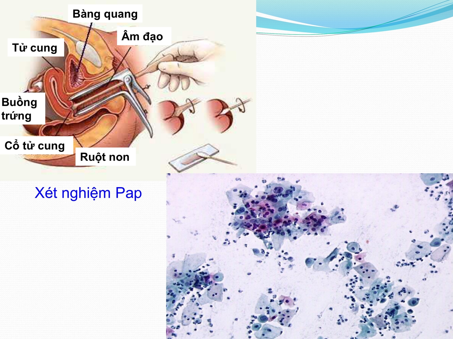 Kĩ thuật làm XN Pap