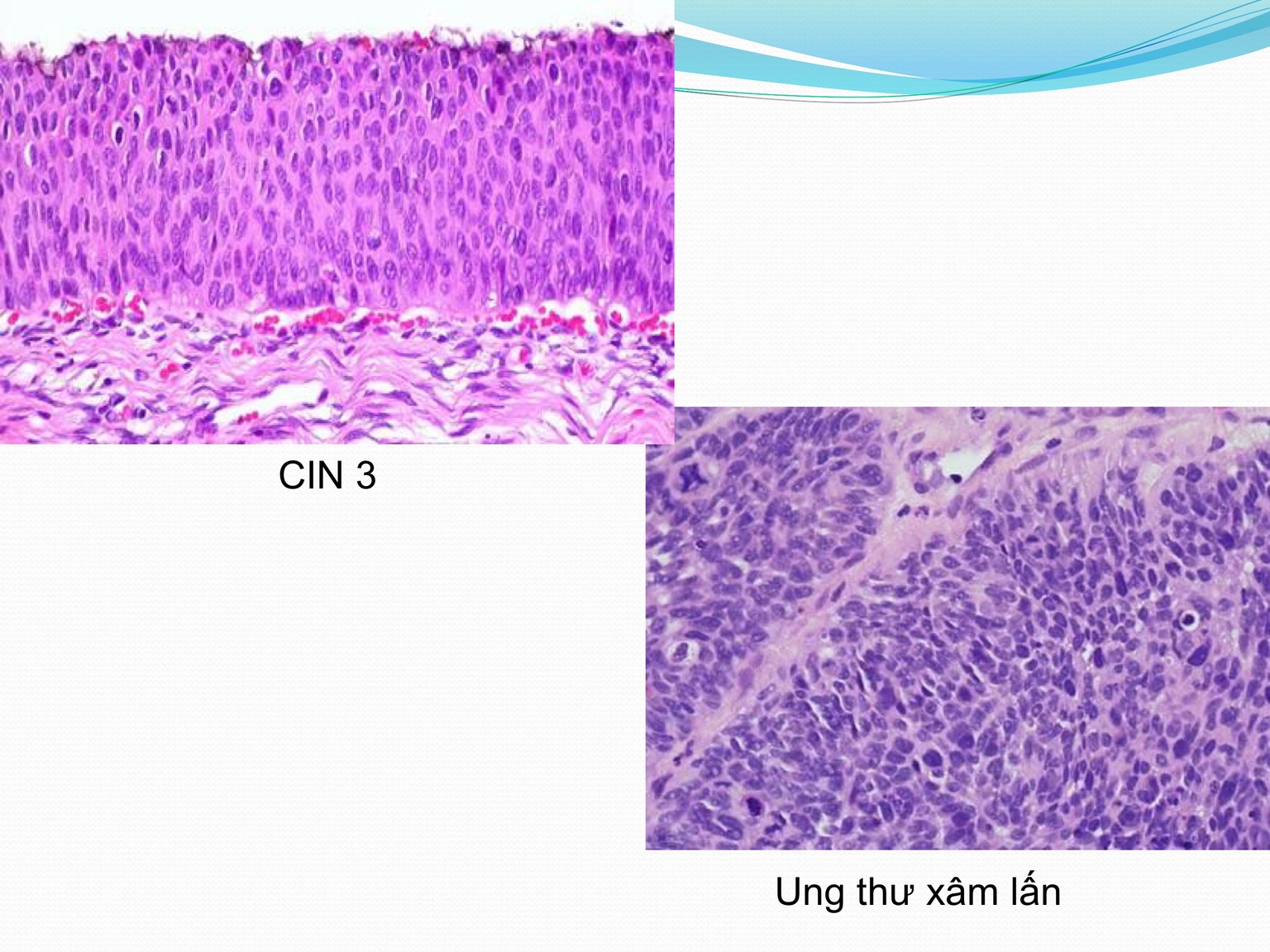 So sánh tử cung bị CIN 3 so với ung thư có xâm lấn