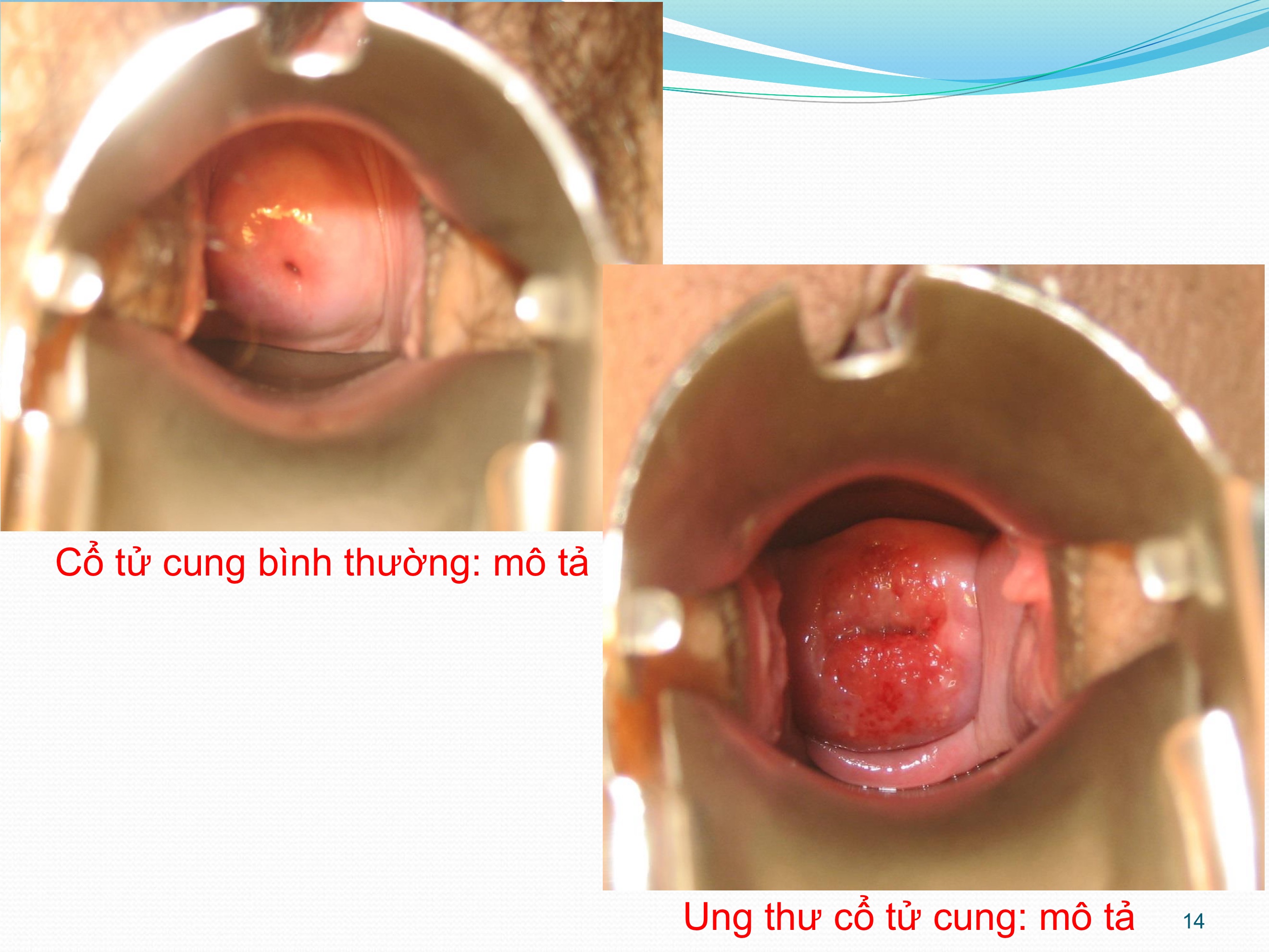 Đại thể cổ tử cung bình thường so với bị ung thư