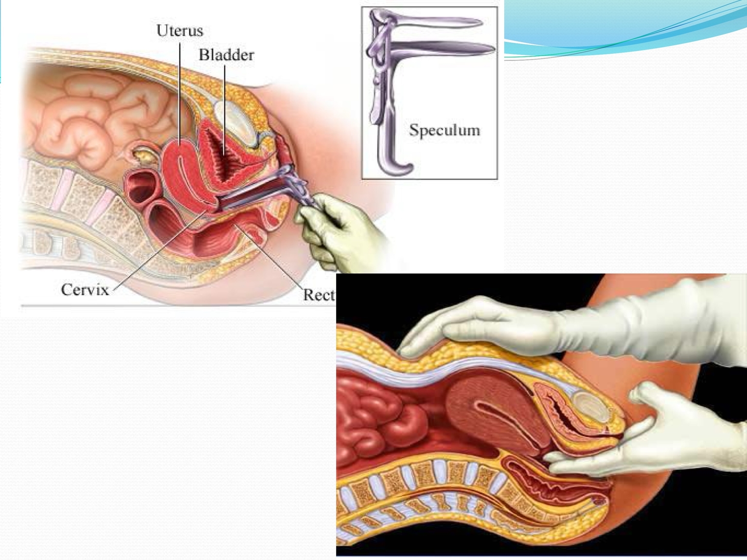 Cách khám cổ tử cung mỏ vịt (speculum)