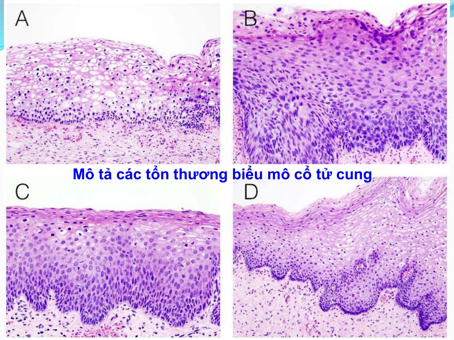 4 mẫu mô TC tổn thương khác nhau