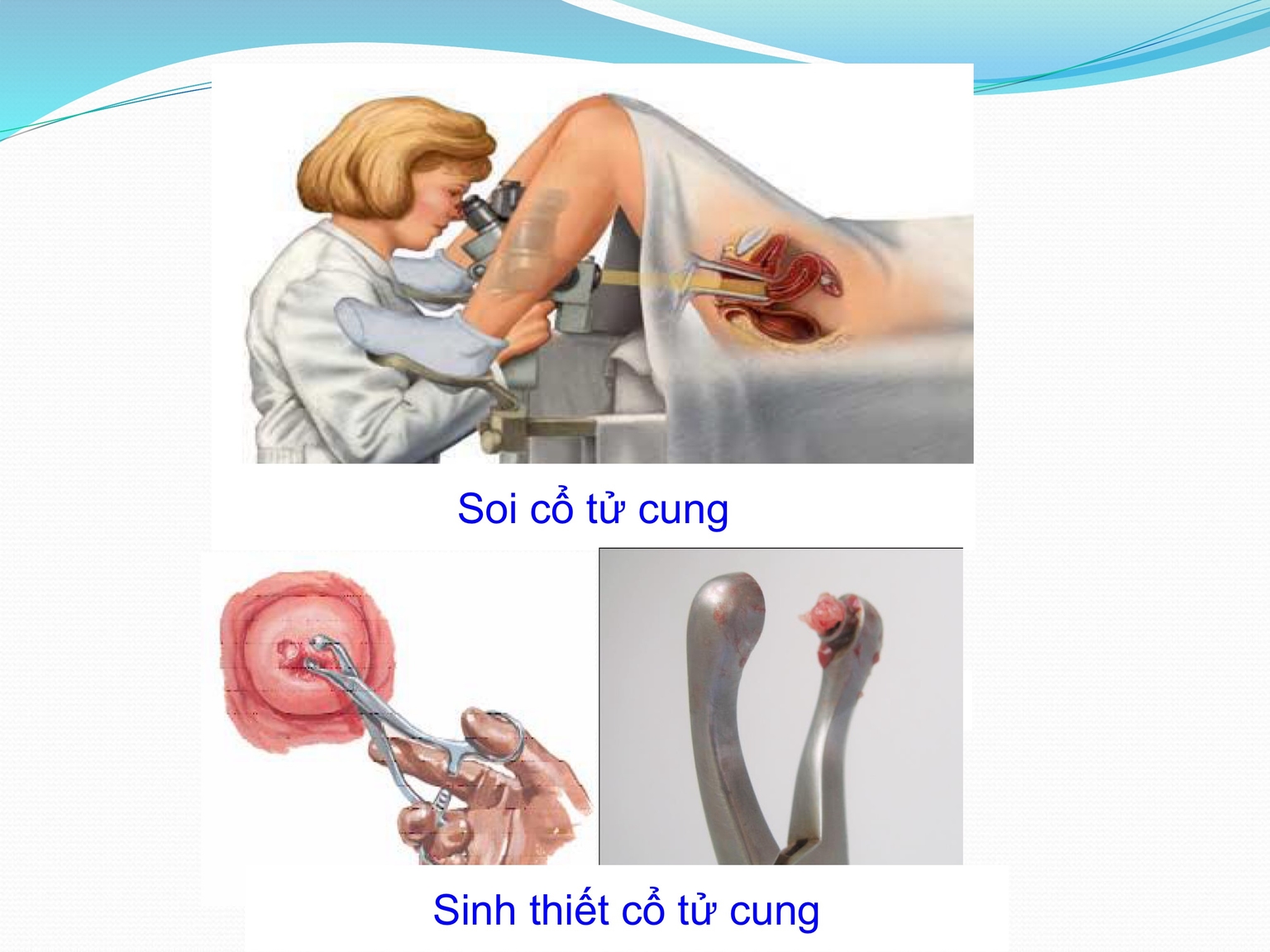 Phương pháp sinh thiết mô TC
