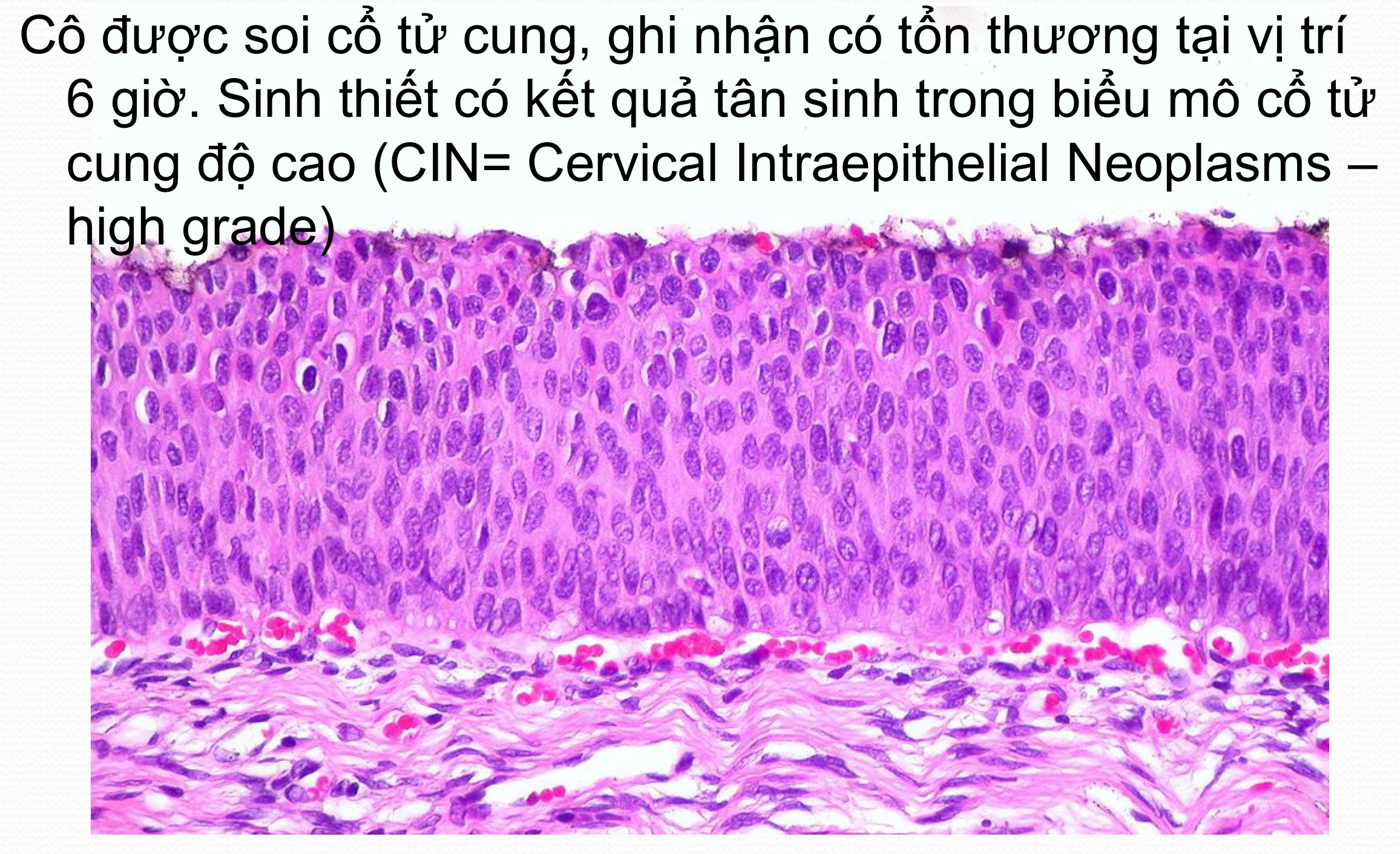 Kết quả soi biểu mô TC