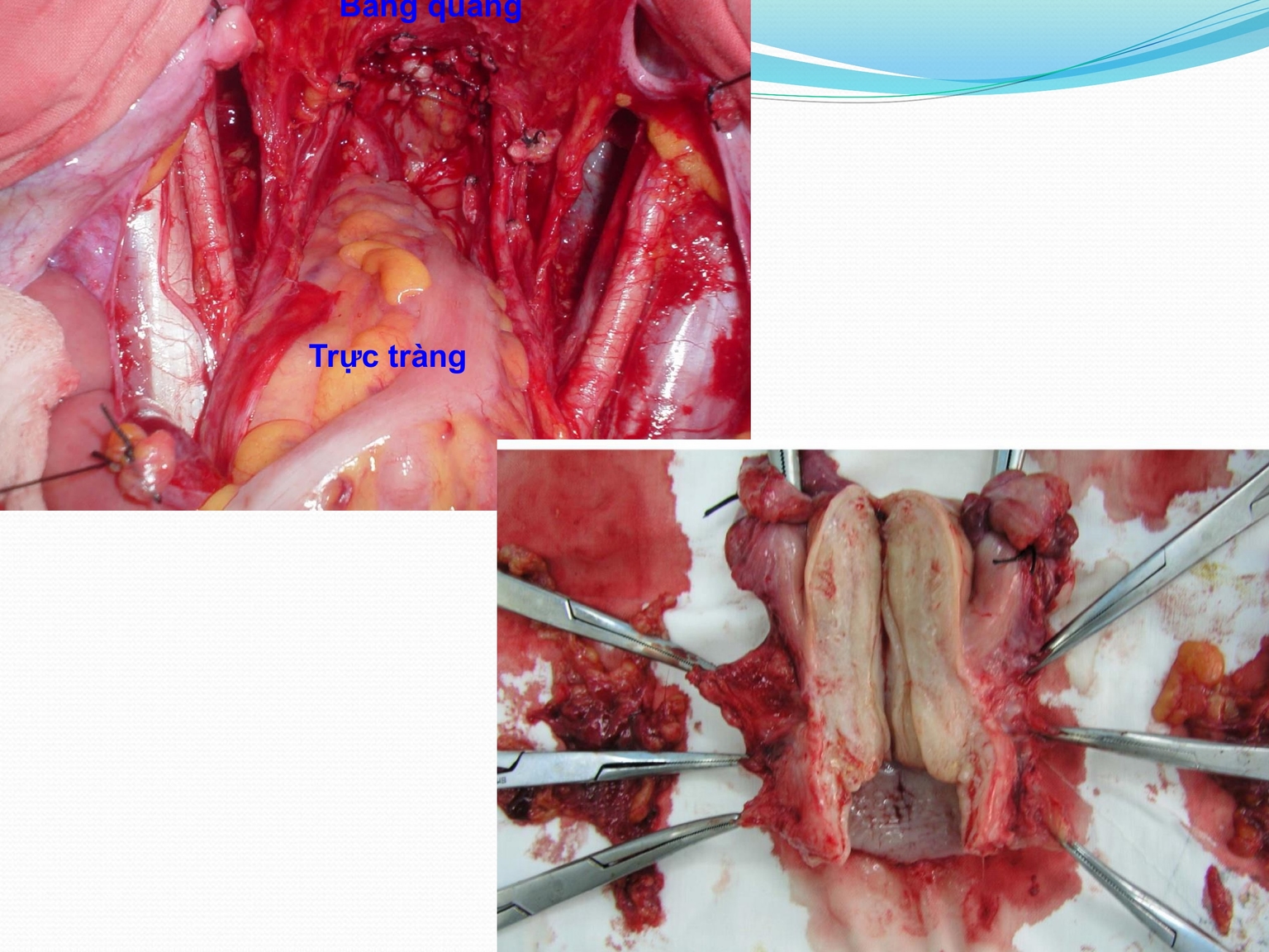 Kết quả phẫu thuật cắt tử cung toàn bộ