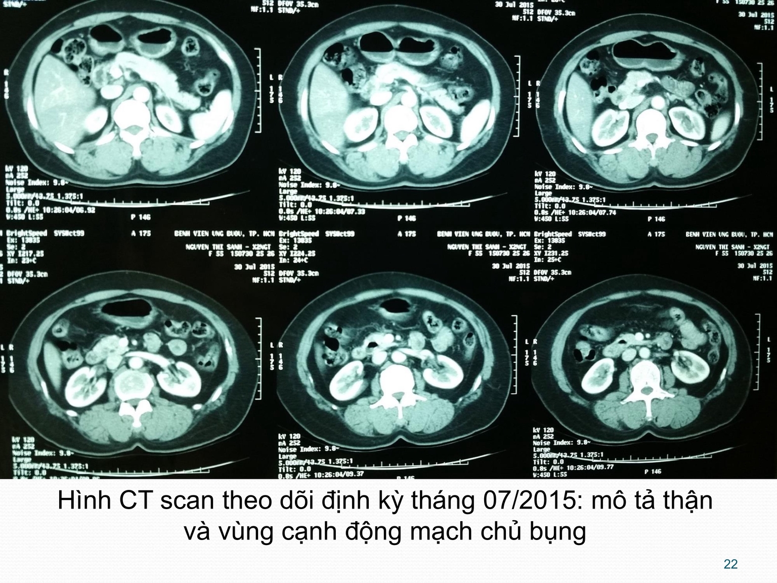 Hình CT scan theo dõi định kỳ tháng 07/2015: mô tả thận và vùng cạnh động mạch chủ bụng