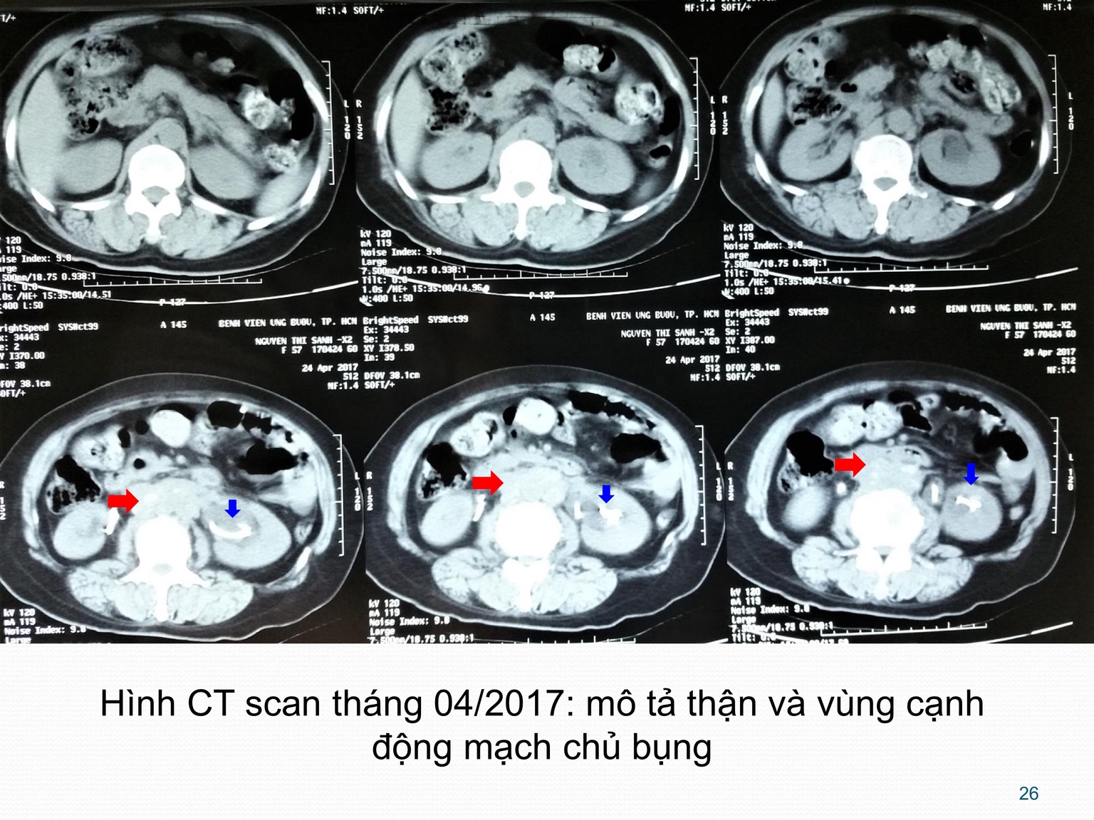 Hình CT scan tháng 04/2017: mô tả thận và vùng cạnh động mạch chủ bụng