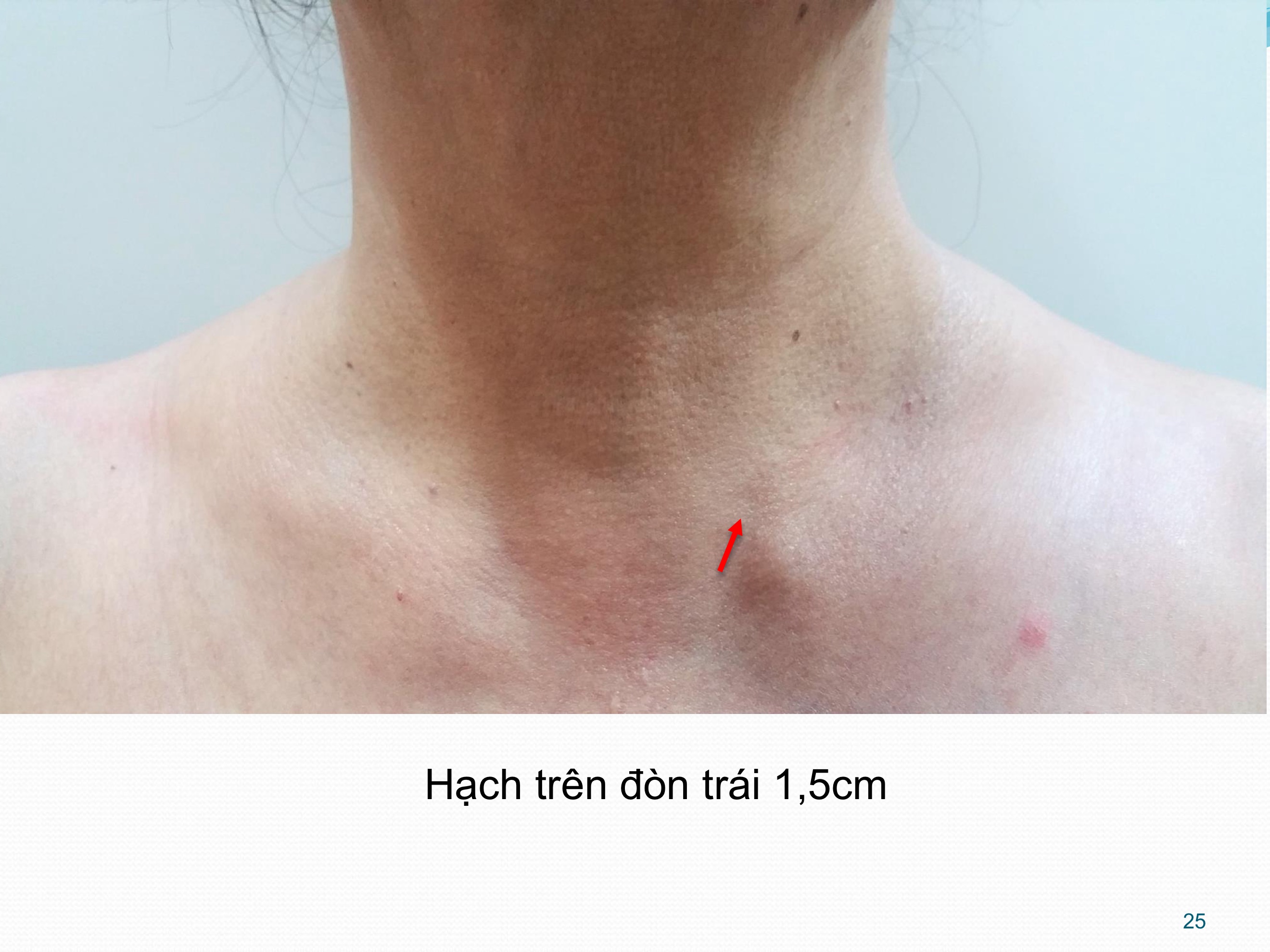 Hạch trên đòn trái 1,5cm