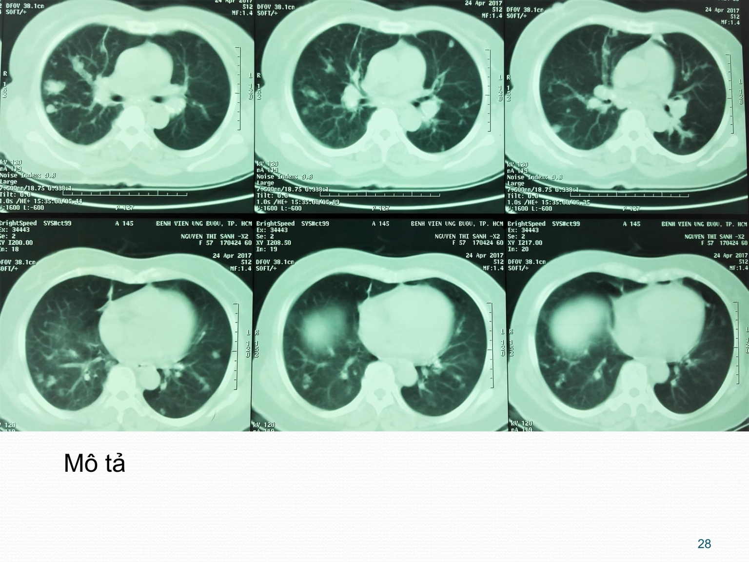 Kết quả X-quang bụng