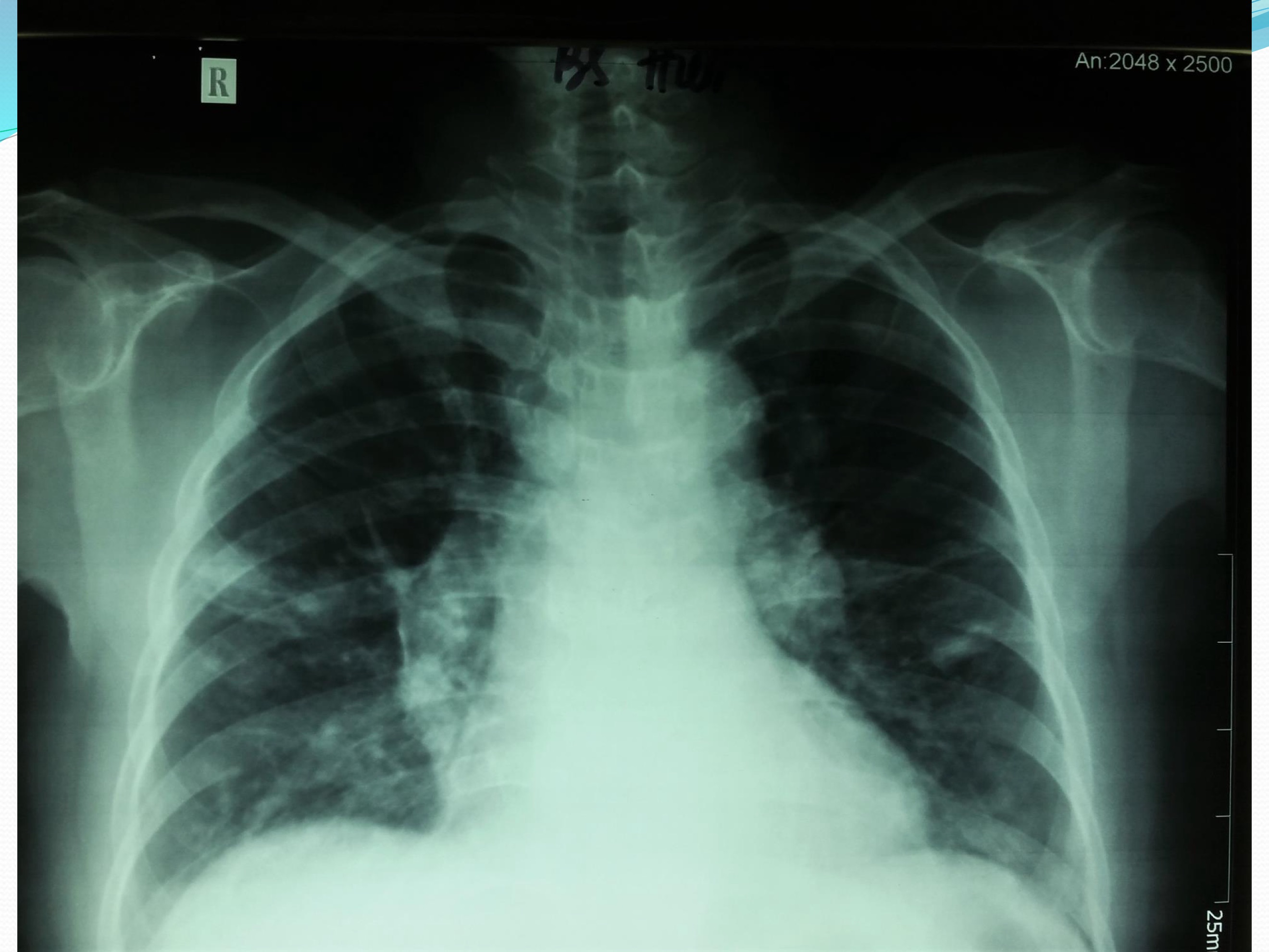 Kết quả X-quang ngực