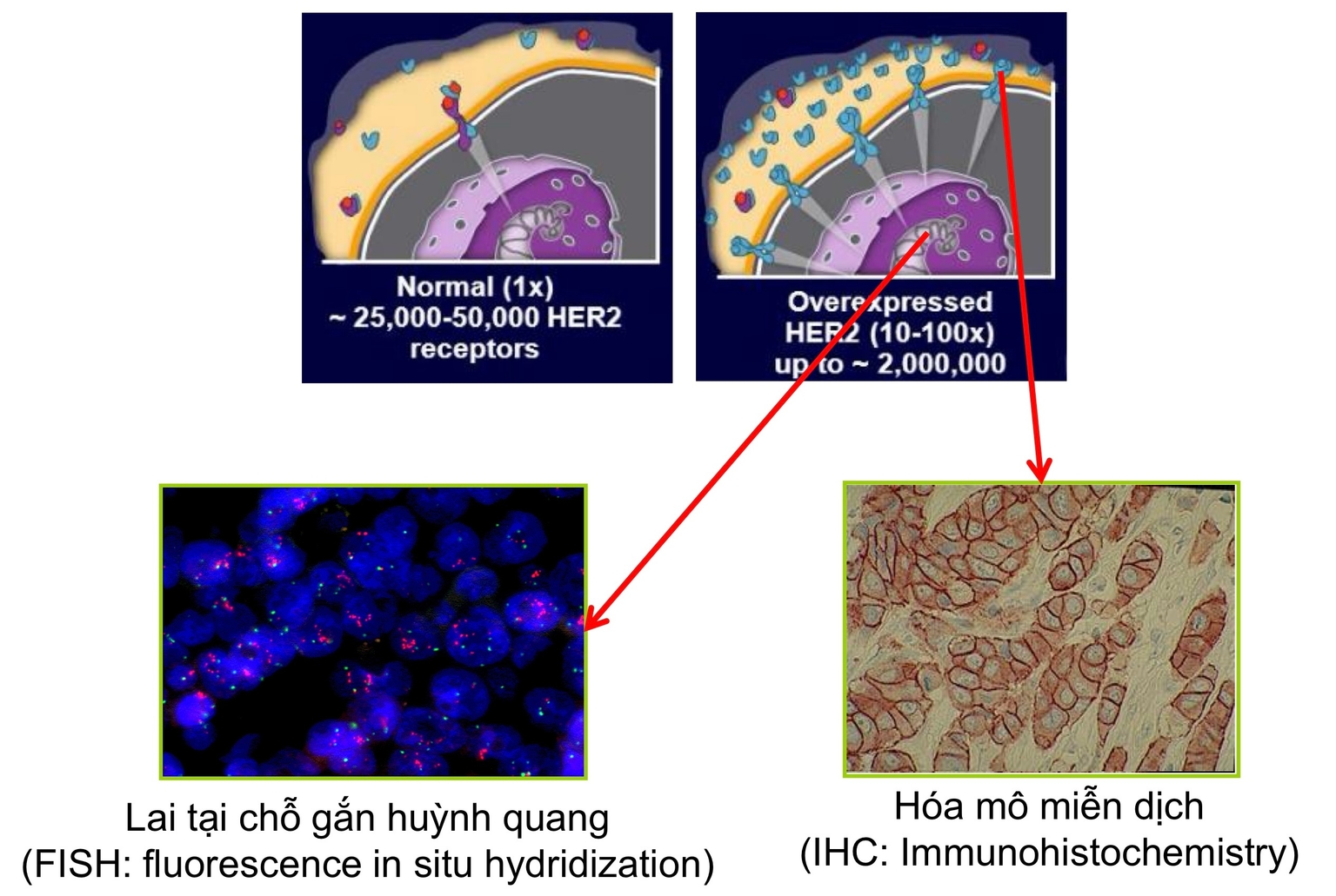 Khuếch đại gene HER2 gây ung thư vú